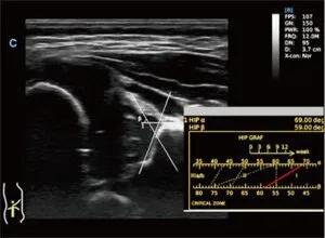 Клинические изображения УЗИ аппарат Chison SonoTouch 80 Pro портативный