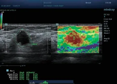 Клинические изображения УЗИ аппарат Mindray DC-80 Exp