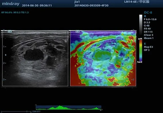 Клинические изображения УЗИ аппарат Mindray DC-8 Exp