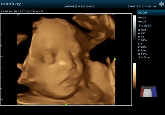 Клинические изображения УЗИ аппарат Mindray DC-30