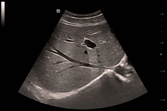 Клинические изображения УЗИ аппарат Mindray DC-45