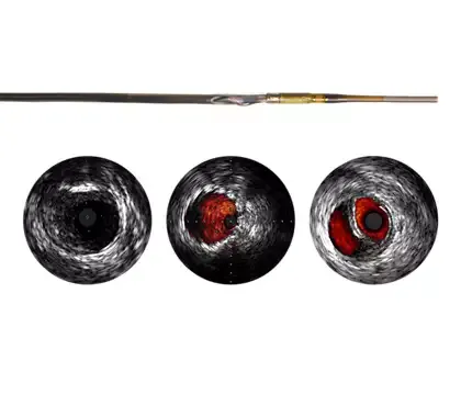 Philips Visions PV (0,018 дюйма) катетер ротационный Philips Visions PV (0,018 дюйма) катетер ротационный