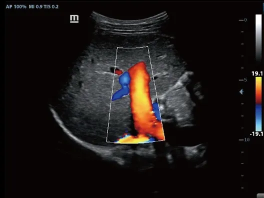 Клинические изображения УЗИ аппарат Mindray Z60 портативный