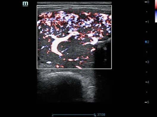 Клинические изображения УЗИ аппарат Mindray DC-70 Exp