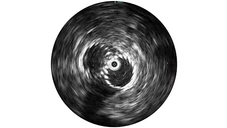 Клинические изображения Philips Visions PV (0,035 дюйма) катетер ротационный