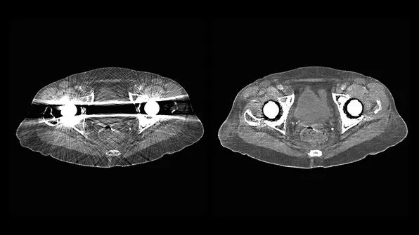 Клинические изображения Siemens SOMATOM go.Now компьютерный томограф