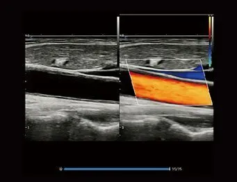 Клинические изображения УЗИ аппарат Chison XBit 80