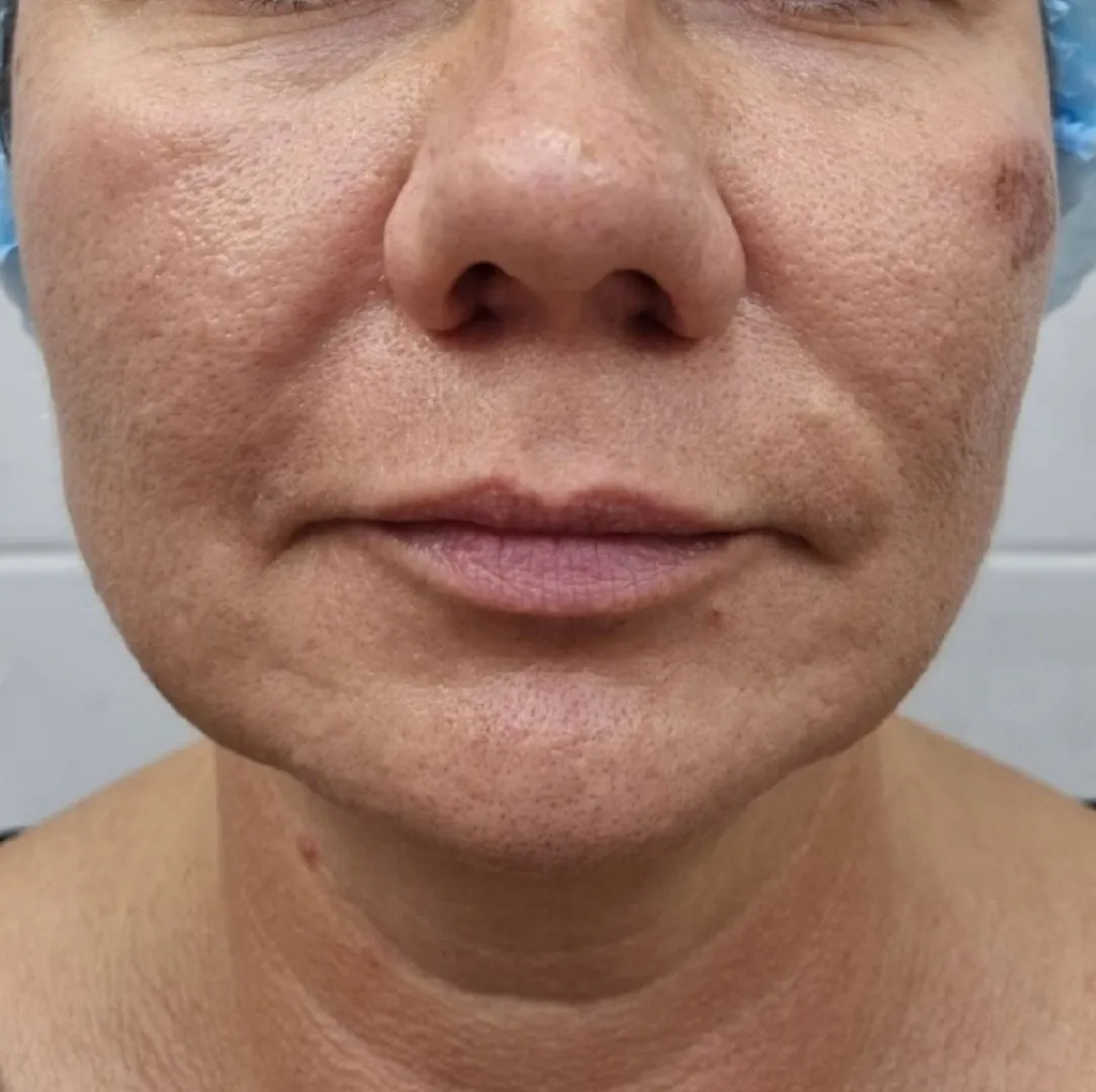 NeoGen омоложение анфас до.jpg NeoGen омоложение анфас до.jpg