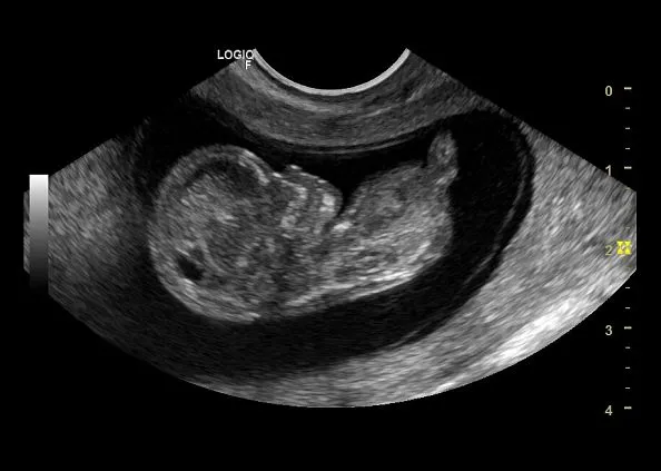 Клинические изображения УЗИ аппарат GE HealthCare Logiq F6