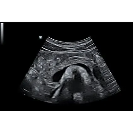 Клинические изображения УЗИ аппарат Mindray DC-70S