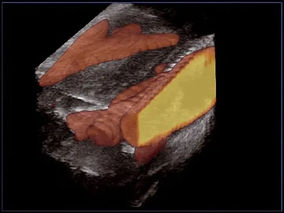 Клинические изображения УЗИ аппарат Esaote MyLab Twice