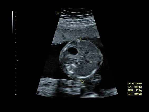 Клинические изображения GE Voluson S6 аппарат УЗИ