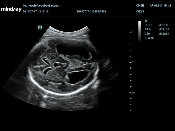 Клинические изображения УЗИ аппарат Mindray DC-70 Pro X-insight