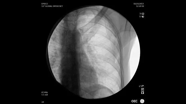 Клинические изображения Рентгенохирургический аппарат типа С-дуга GE OEC Elite II