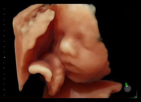 Клинические изображения Ультразвуковая диагностическая система GE HealthCare Voluson E6