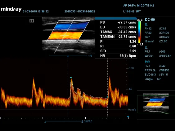 Клинические изображения УЗИ аппарат Mindray DC-55