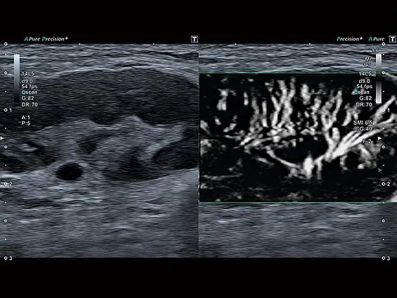 Клинические изображения Canon (Toshiba) Aplio a550 аппарат УЗИ