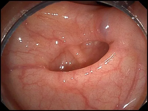 Клинические изображения SonoScape HD-350 видеоэндоскопическая система