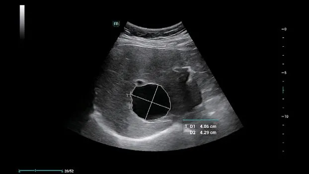 Клинические изображения УЗИ аппарат Mindray Consona N6