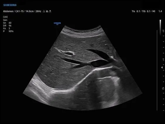 Клинические изображения Samsung Medison V7 УЗИ аппарат