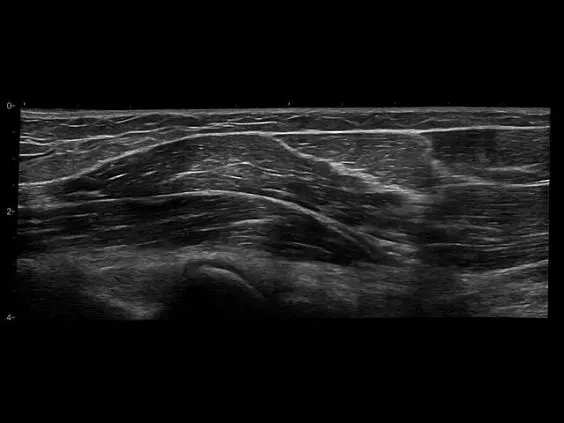 Клинические изображения GE HealthCare Venue Go УЗИ аппарат портативный