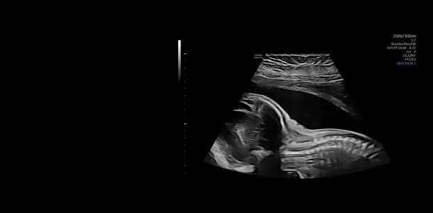 Клинические изображения УЗИ аппарат GE HealthCare Voluson Expert 20