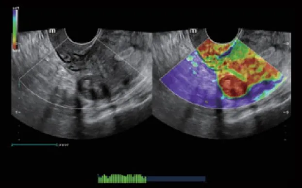 Клинические изображения УЗИ аппарат Mindray Imagyn I9