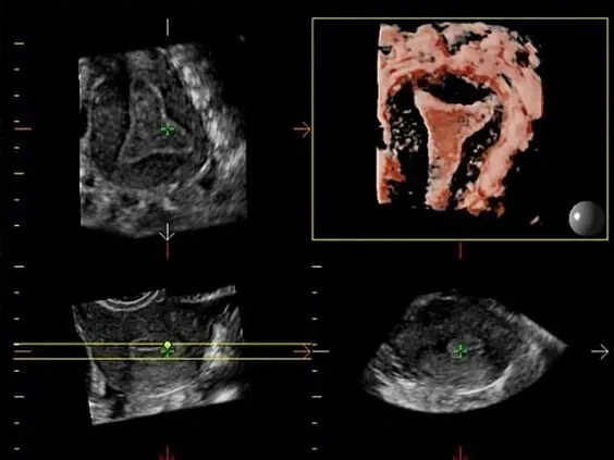 Клинические изображения УЗИ аппарат Esaote MyLab Eight