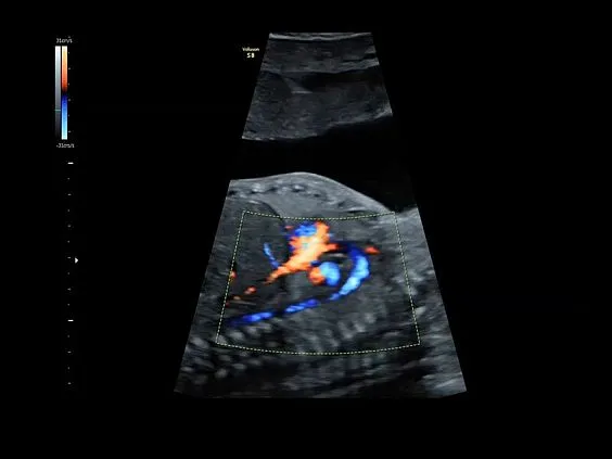 Клинические изображения GE Voluson S6 аппарат УЗИ