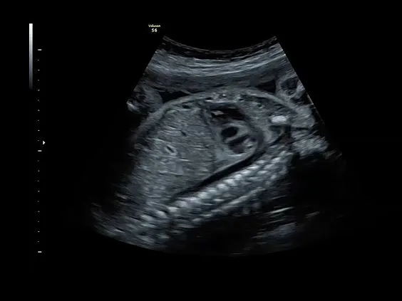 Клинические изображения GE Voluson S6 аппарат УЗИ