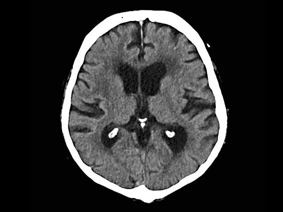 Клинические изображения Siemens SOMATOM go.Now компьютерный томограф