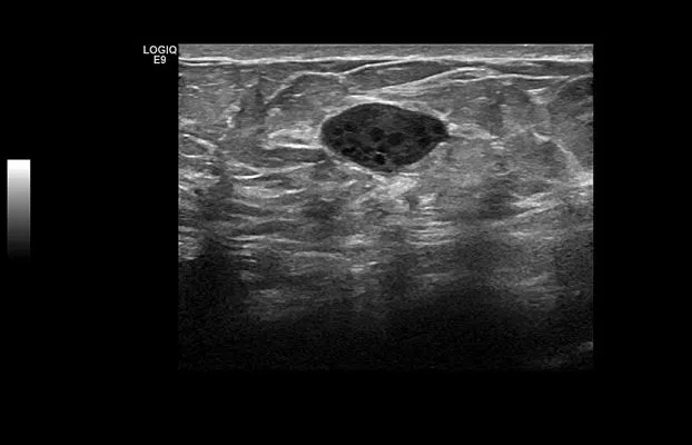 Клинические изображения GE Logiq S8 XDclear ультразвуковая диагностическая система