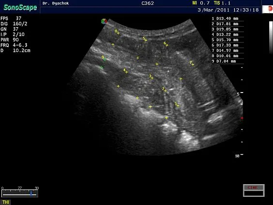 Клинические изображения Sonoscape S9 ультразвуковой аппарат