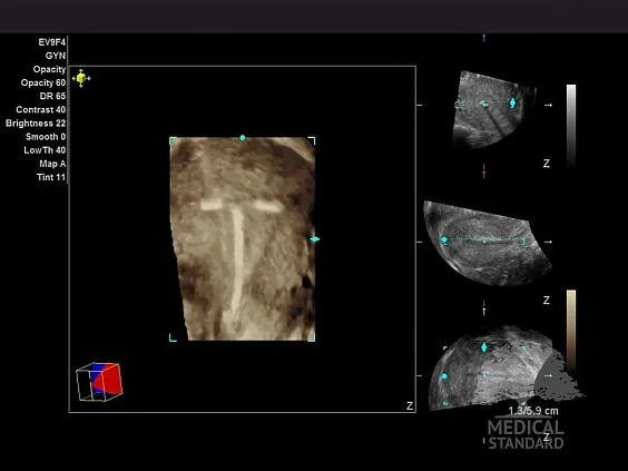 Клинические изображения Ультразвуковой аппарат Siemens Acuson X300 Premium Edition