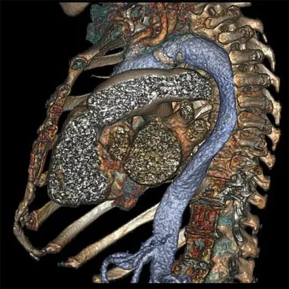 Клинические изображения GE HealthCare Revolution CT компьютерный томограф