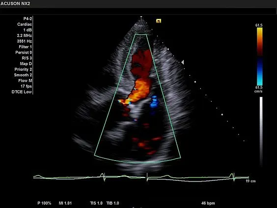 Клинические изображения Siemens Acuson NX2 Elite аппарат УЗИ