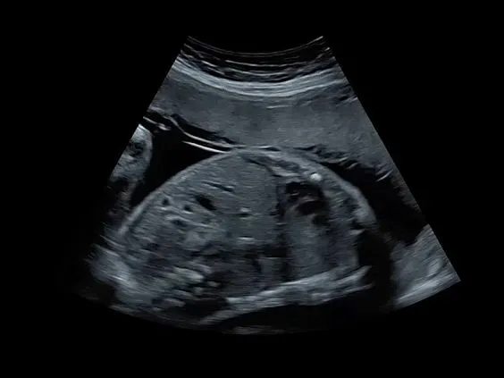 Клинические изображения GE Voluson S6 аппарат УЗИ