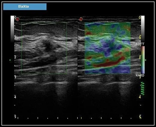 Клинические изображения УЗИ аппарат Esaote MyLab X7