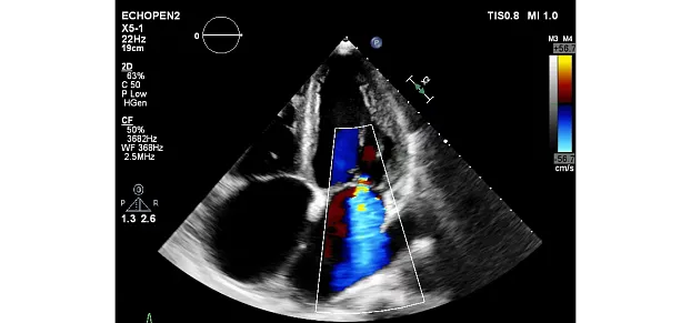 Клинические изображения Philips EPIQ CVx ультразвуковой аппарат