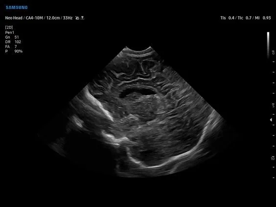 Клинические изображения Samsung Medison V8 УЗИ аппарат