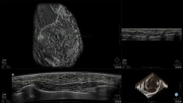 Клинические изображения GE HealthCare Invenia ABUS ультразвуковая система