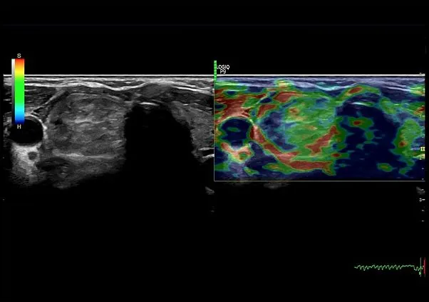 Клинические изображения GE Logiq P9 ультразвуковая диагностическая система