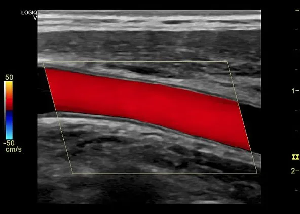 Клинические изображения Ультразвуковая диагностическая система GE Logiq V2 УЗИ портативная