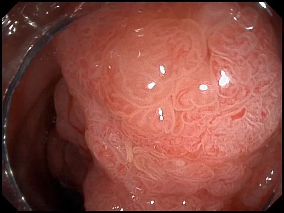 Клинические изображения SonoScape HD-320 видеоэндоскопическая система