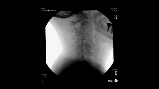 Клинические изображения Рентгенохирургический аппарат типа С-дуга GE OEC Elite CFD