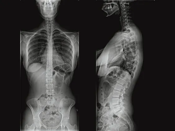 Клинические изображения Рентгеновский денситометр GE Lunar iDXA