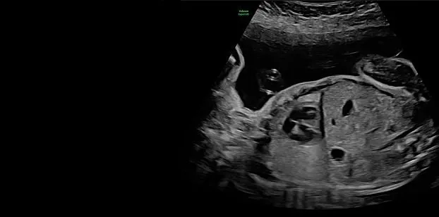 Клинические изображения УЗИ аппарат GE HealthCare Voluson Expert 20