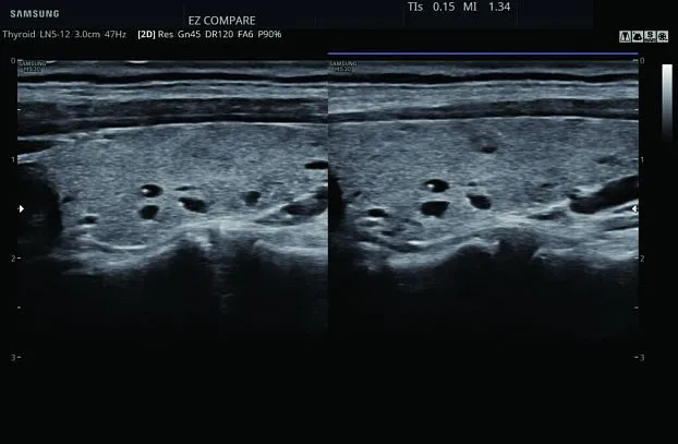 Клинические изображения Samsung Medison HS30 УЗИ аппарат