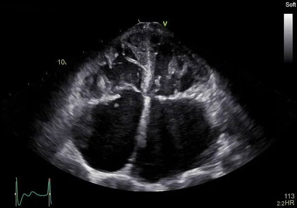 Клинические изображения УЗИ аппарат GE HealthCareVivid E90