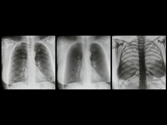 Клинические изображения Цифровой рентгенографический аппарат GE Discovery XR656 HD